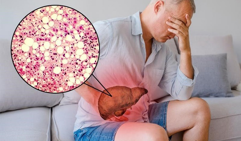 Bệnh men gan cao là gì? Nguyên nhân, triệu chứng và cách phòng ngừa