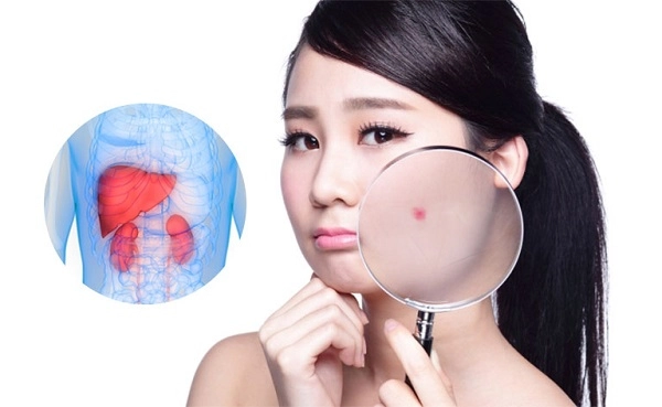 Bị nóng gan nổi mẩn ngứa phải làm sao? Nên dùng thuốc gì?