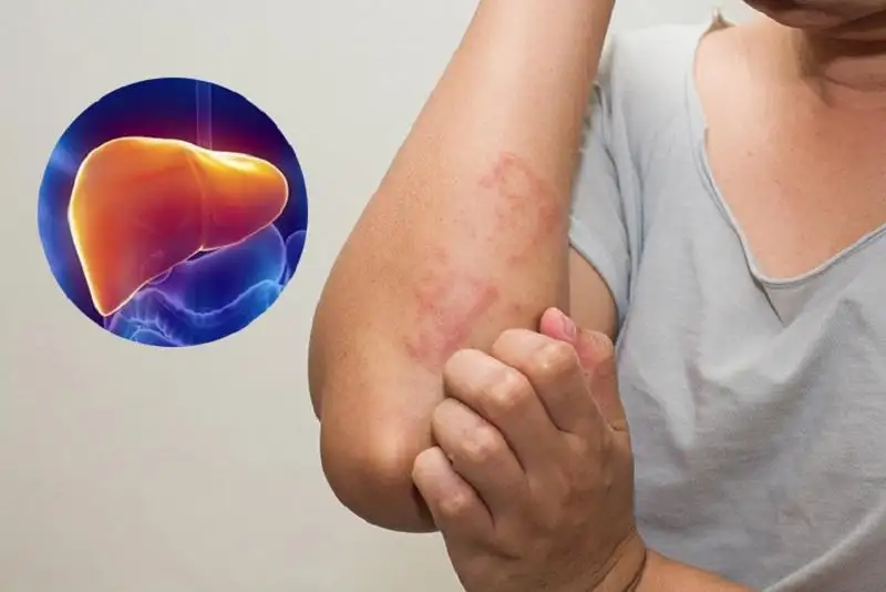 Bị nóng gan nổi mẩn ngứa phải làm sao? Nên dùng thuốc gì?