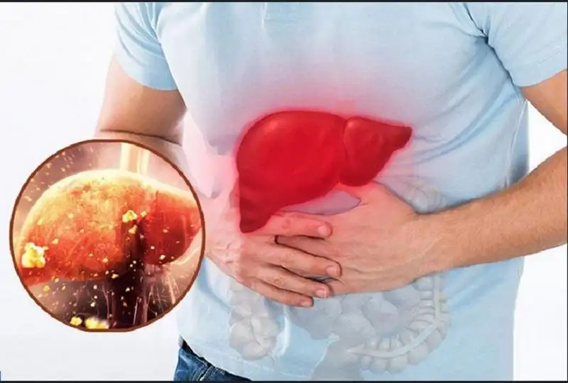 Bệnh men gan cao là gì? Nguyên nhân, triệu chứng và cách phòng ngừa