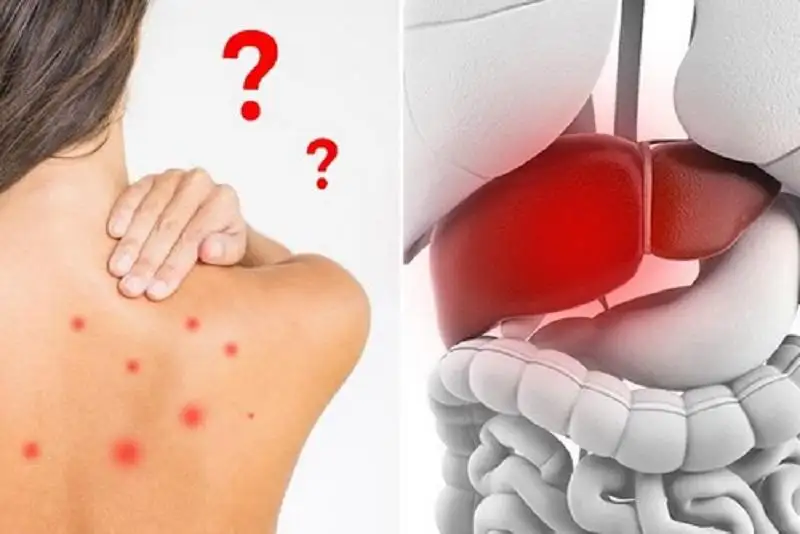 Tại sao Glutathione hiệu quả trong dị ứng nóng gan