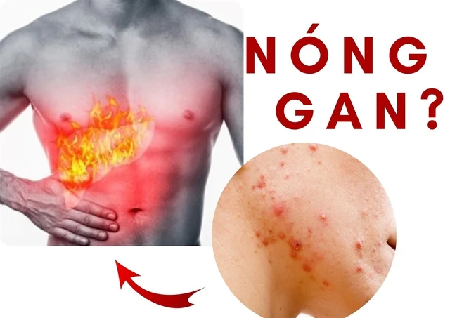 Tại sao Glutathione hiệu quả trong dị ứng nóng gan