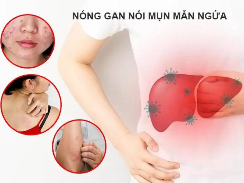 Delexxco lưu ý khi dùng thuốc giải độc gan nóng nổi mẩn